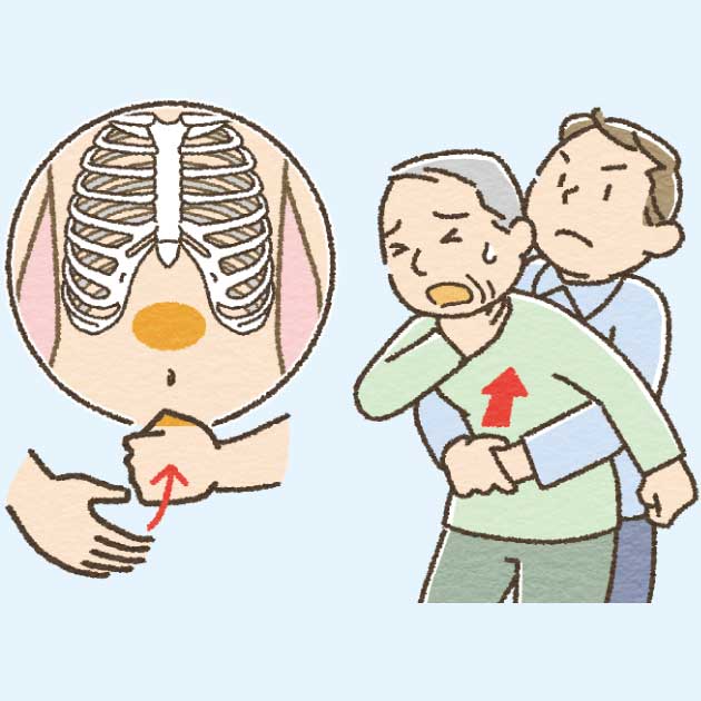 ハイムリック法のイラスト