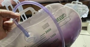 紫色に変色した膀胱留置カテーテルの尿バッグ（紫色尿バッグ症候群）